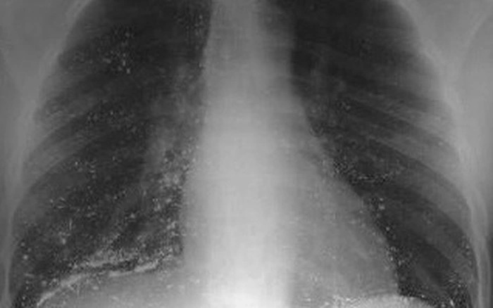 Hình ảnh phổi của người hít phải thủy ngân